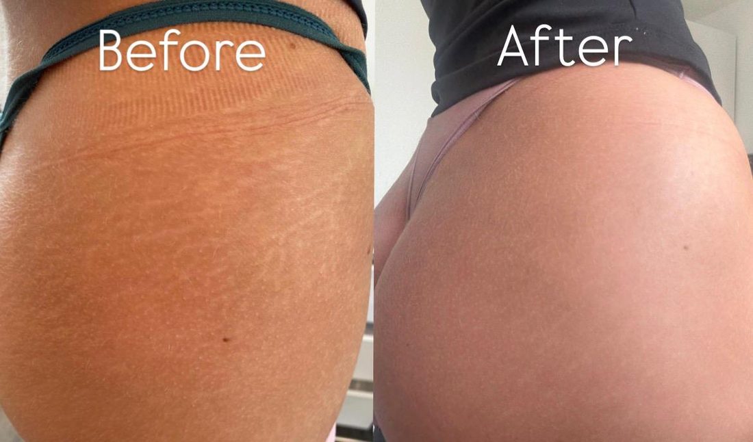 Before and after stretch mark camouflage on the glutes at Scargo Clinic